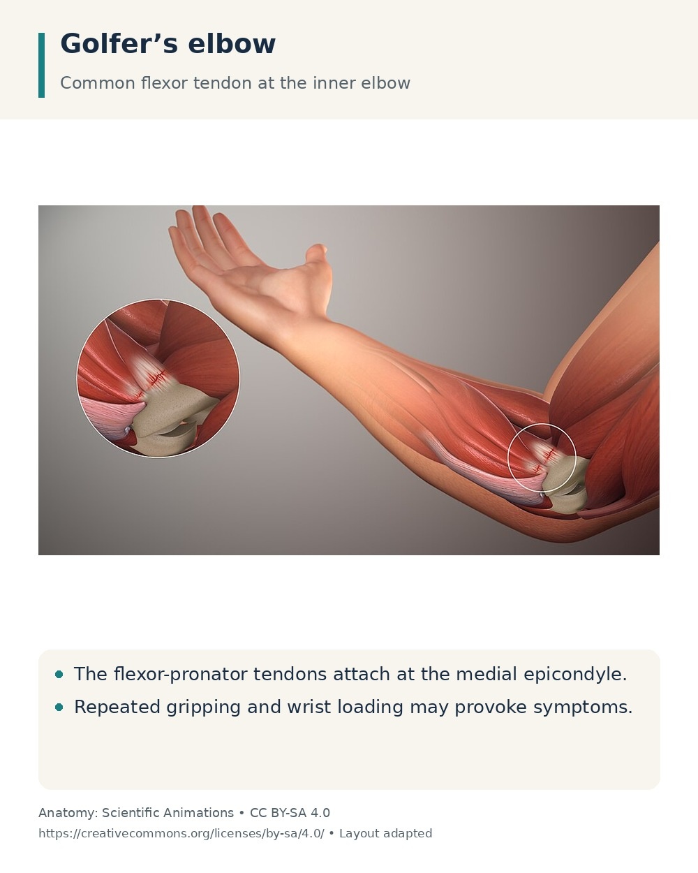 Inner elbow anatomy showing the flexor-pronator tendon attachment at the medial epicondyle.