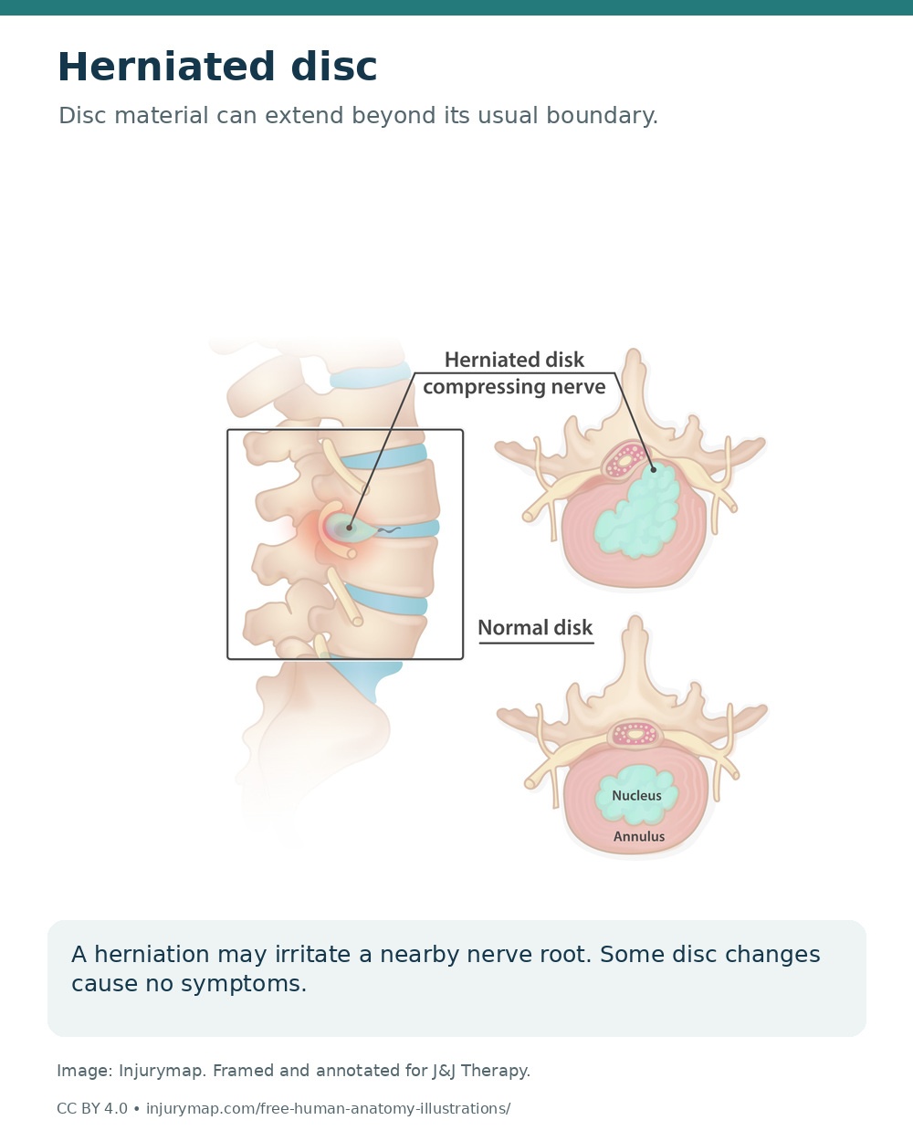 Lumbar disc herniation in side and cross-sectional views, showing disc material near a nerve root.