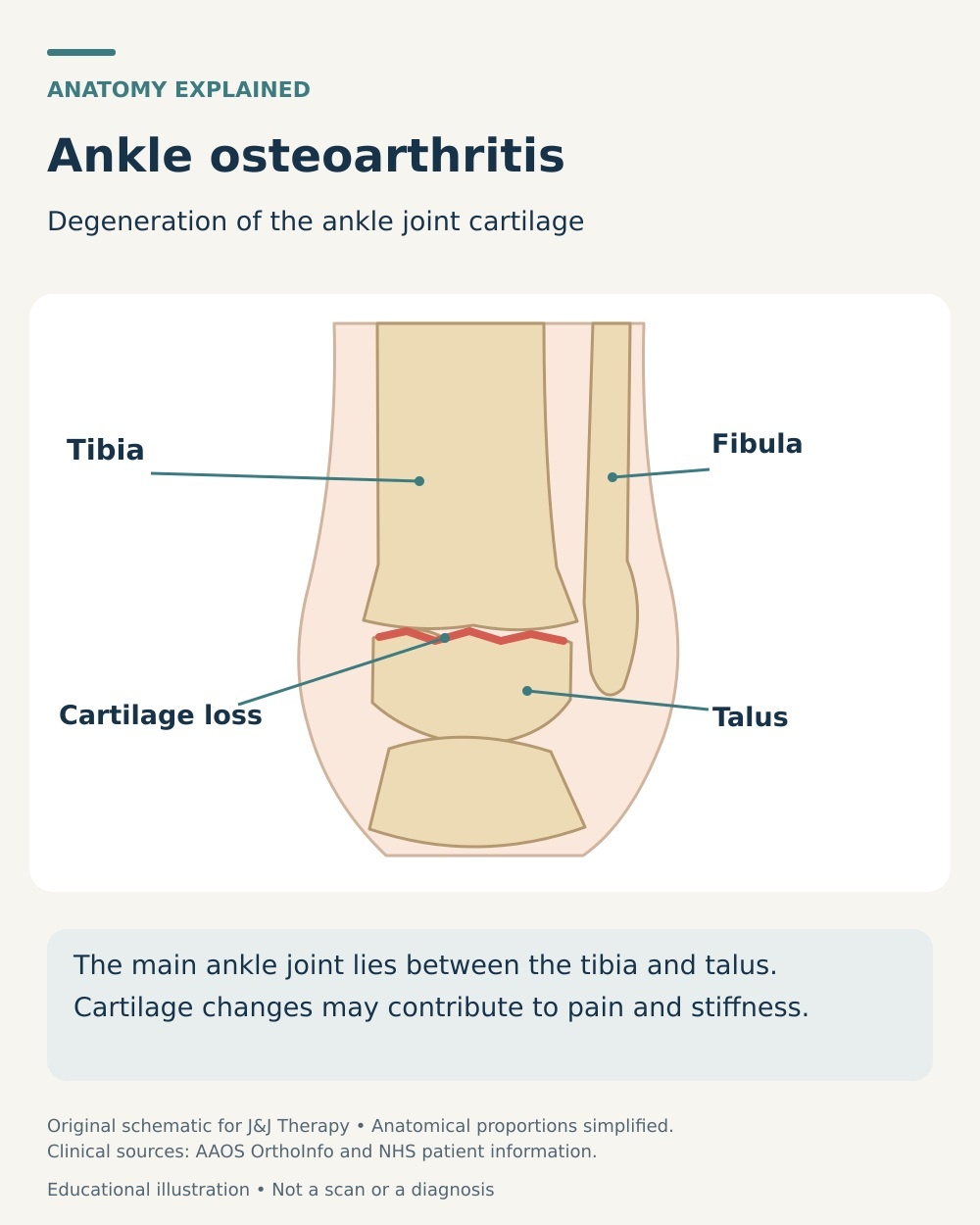 Ankle osteoarthritis diagram showing cartilage loss between the tibia and talus, with the neighbouring fibula labelled.
