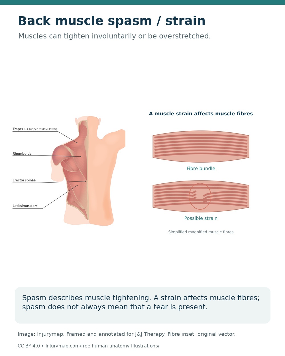 Back muscle anatomy and a magnified schematic comparing continuous muscle fibres with a possible strain.