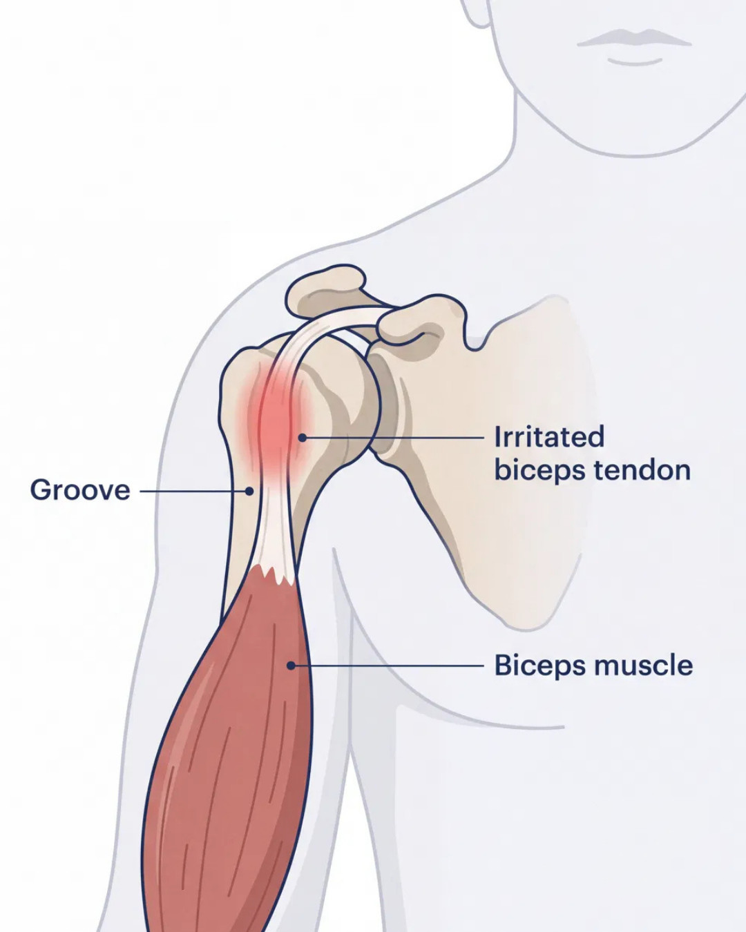 Diagram showing an irritated long-head biceps tendon in the groove at the front of the shoulder.