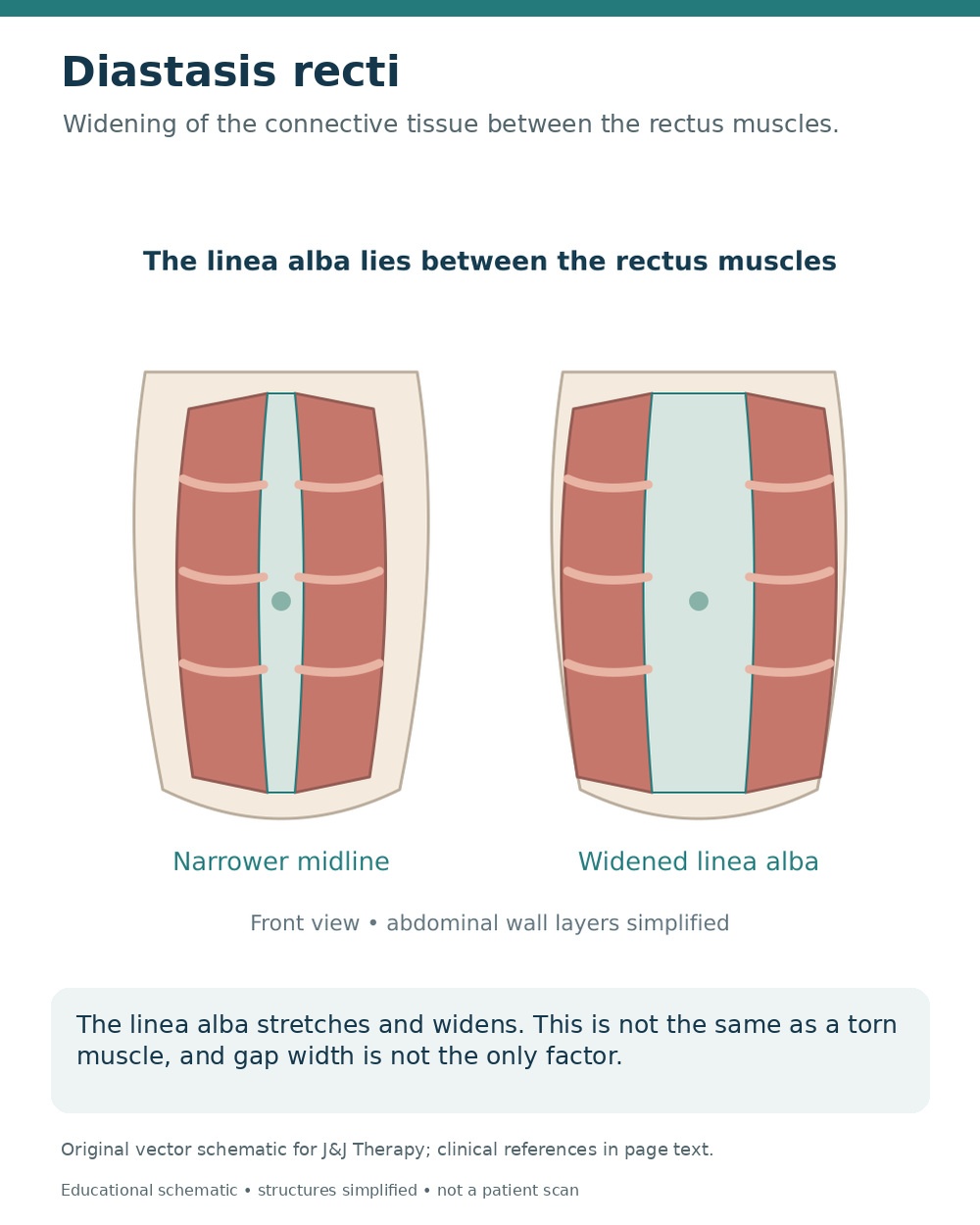 Comparison of rectus abdominis muscles with a narrower and a widened linea alba in diastasis recti.