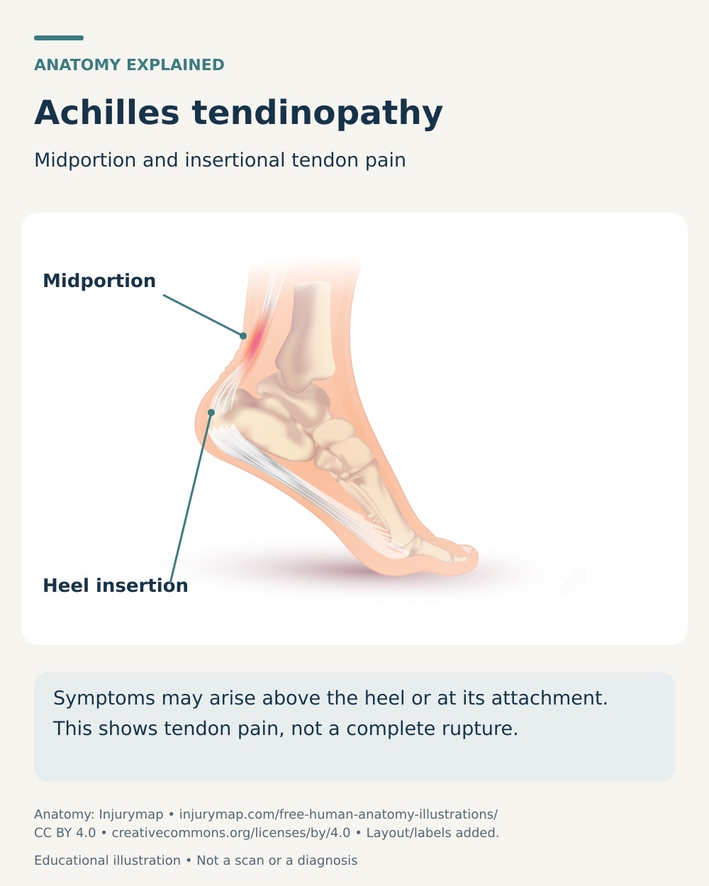 Anatomical foot cutaway distinguishing midportion Achilles tendon pain from pain at its attachment to the back of the heel.