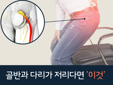 엉덩이와 다리가 저릿저릿? ‘이상근 증후군’을 의심하세요!