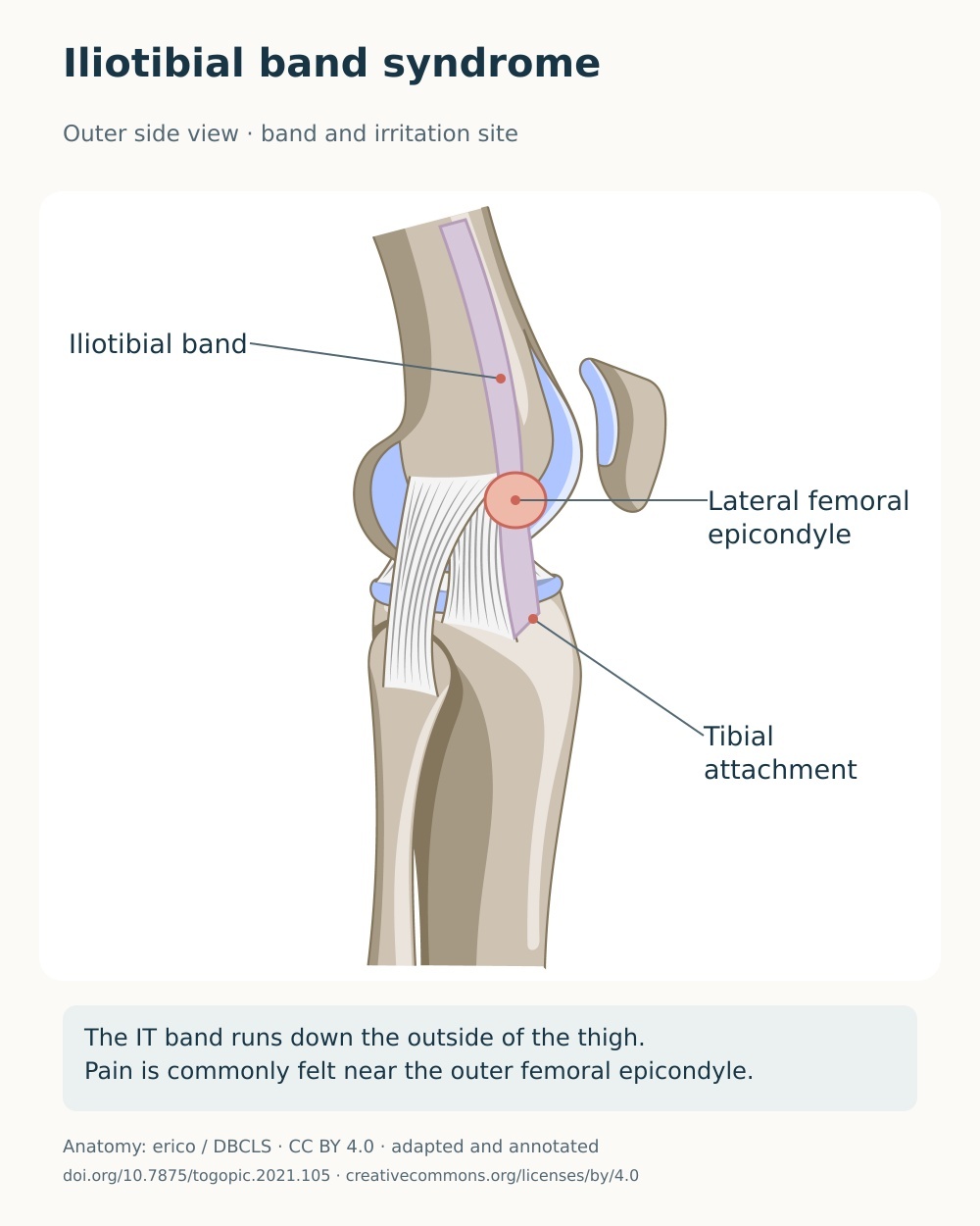 Lateral knee anatomy showing the iliotibial band, lateral femoral epicondyle and tibial attachment.