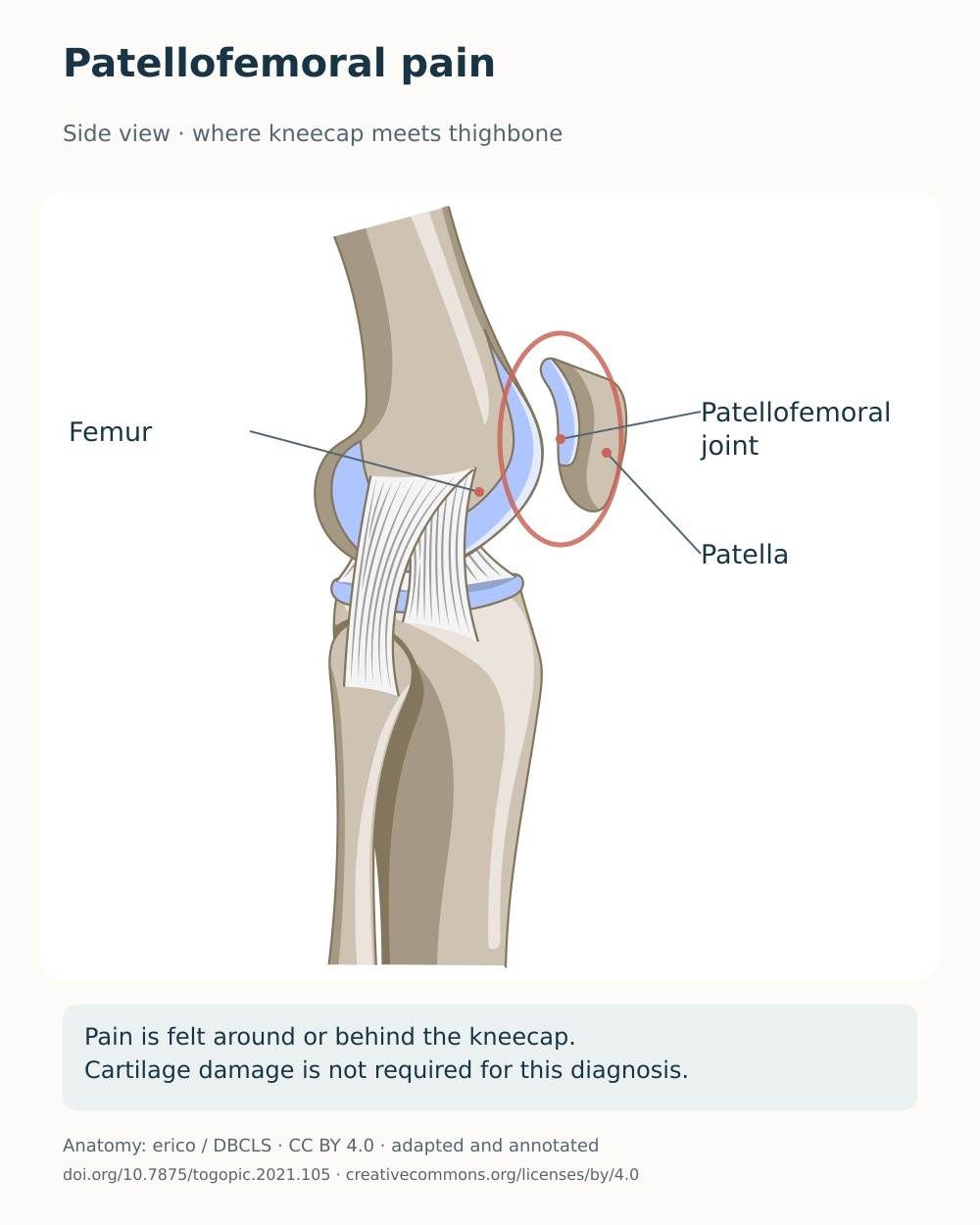 Lateral knee anatomy identifying the joint between the kneecap and the femoral groove.