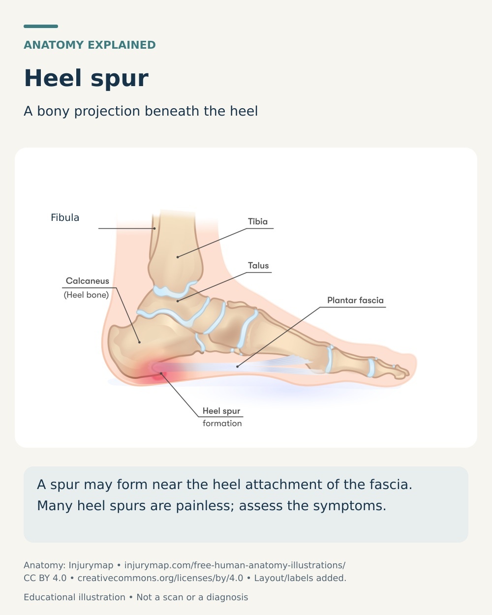 Anatomical cutaway of a plantar heel spur beneath the calcaneus near the plantar fascia attachment.