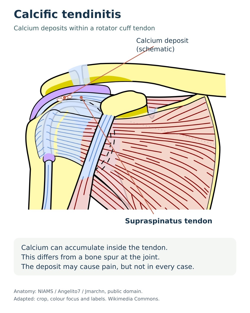 Anatomical diagram showing schematic calcium deposits inside the supraspinatus tendon.