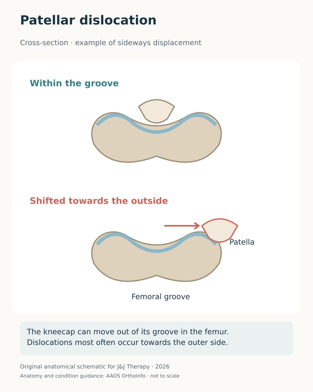 Cross-sectional diagram comparing a kneecap within its femoral groove with lateral patellar dislocation.