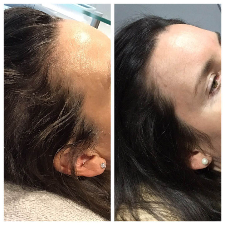Hair Restoration