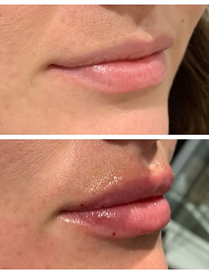 LipFiller.jpeg