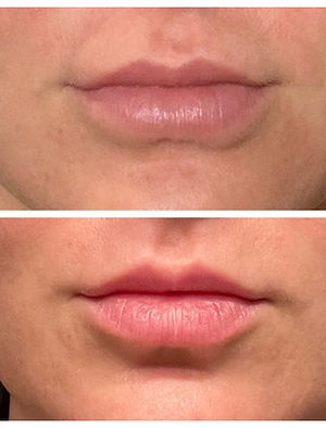 Lip Filler Dissolving