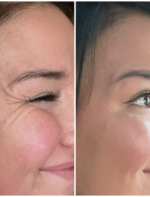 tox before and after