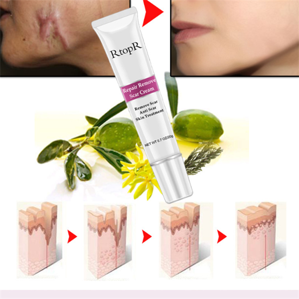 Thumbnail: Acne Scar Removal Cream for Skin Repair and Healing