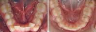 Closer look into orthodontic treatment at Family orthodontics in Milford MA, Westborough MA & Grafton MA.