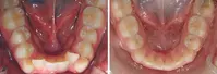 Closer look into orthodontic treatment at Family orthodontics in Milford MA, Westborough MA & Grafton MA.
