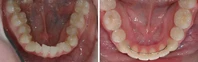 Closer look into orthodontic treatment at Family orthodontics in Milford MA, Westborough MA & Grafton MA.