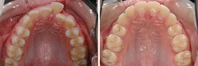 Closer look into orthodontic treatment at Family orthodontics in Milford MA, Westborough MA & Grafton MA.