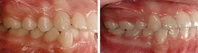 Closer look into orthodontic treatment at Family orthodontics in Milford MA, Westborough MA & Grafton MA.