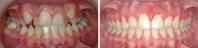 Closer look into orthodontic treatment at Family orthodontics in Milford MA, Westborough MA & Grafton MA.