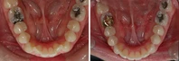 Closer look into orthodontic treatment at Family orthodontics in Milford MA, Westborough MA & Grafton MA.