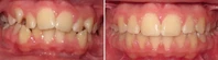 Closer look into orthodontic treatment at Family orthodontics in Milford MA, Westborough MA & Grafton MA.