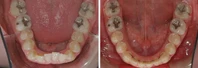 Closer look into orthodontic treatment at Family orthodontics in Milford MA, Westborough MA & Grafton MA.