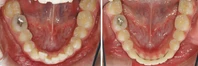 Closer look into orthodontic treatment at Family orthodontics in Milford MA, Westborough MA & Grafton MA.