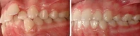 Closer look into orthodontic treatment at Family orthodontics in Milford MA, Westborough MA & Grafton MA.