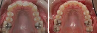 Closer look into orthodontic treatment at Family orthodontics in Milford MA, Westborough MA & Grafton MA.