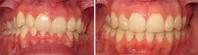 Closer look into orthodontic treatment at Family orthodontics in Milford MA, Westborough MA & Grafton MA.