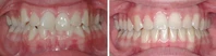 Closer look into orthodontic treatment at Family orthodontics in Milford MA, Westborough MA & Grafton MA.