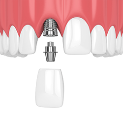 implants 1.gif