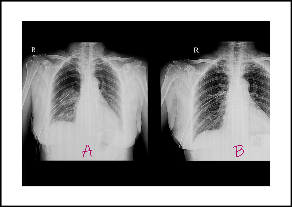 Understanding Pleural Effusion Causes and Nursing interventions