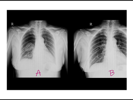 Understanding Pleural Effusion: Causes and Nursing interventions