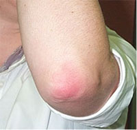 STAGE I pressure ulcer