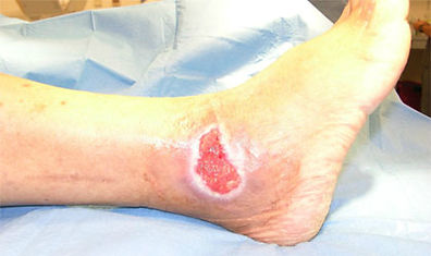 Pressure ulcer