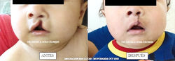 Fisura Labial unilateral