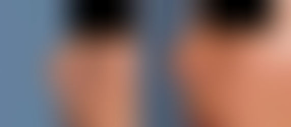 RINOPLASTÍA SECUNDARIA