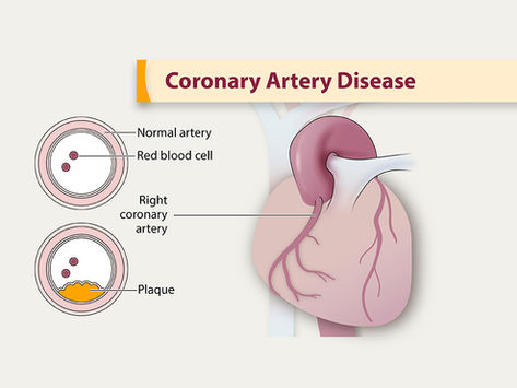 VESALIUS-CV Çalışması: Diyabetli Hastalarda Erken ve Yoğun LDL Tedavisinin Önemi