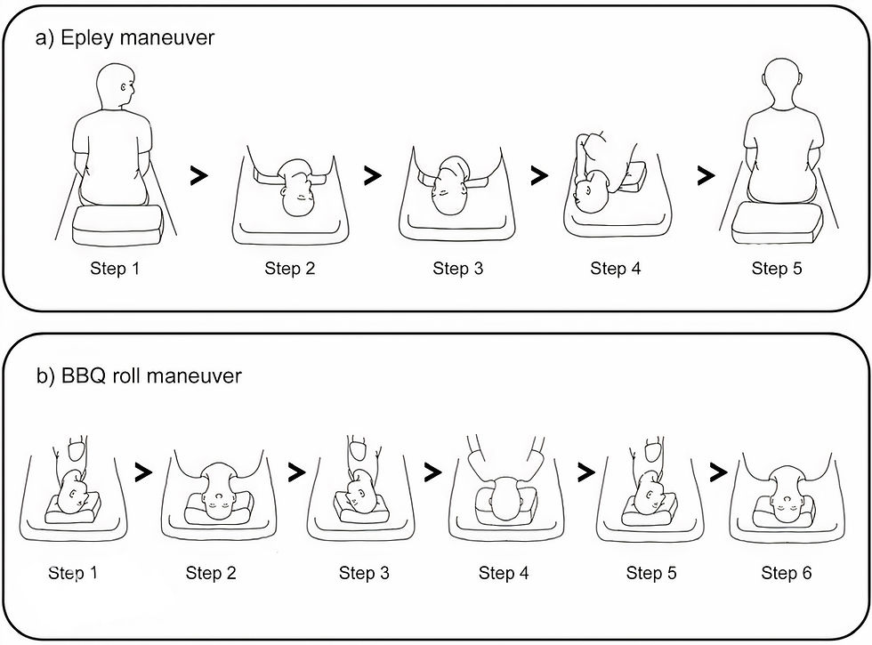 Epley manoeuvre diagram epley maneuver vertigo bppv rosh man