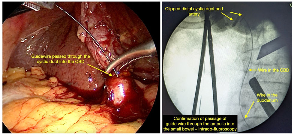 Steps of a Rendezvous procedure - Bypassing the difficult aspect of passing a wire into the Common bile duct during ERCP by passing it laparoscopically during cholecystectomy