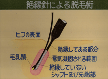 絶縁針による脱毛術.gif