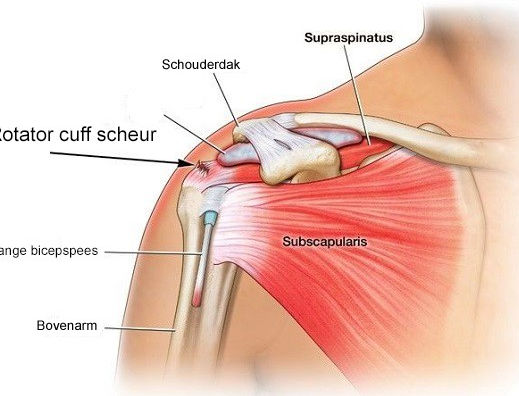 Mc Connell Rotator-cuff-scheur schouder.jpg