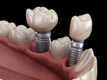 The Advantages of Dental Implants: A Superior Choice for Tooth Replacement