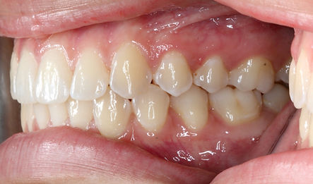 left profile of mouth