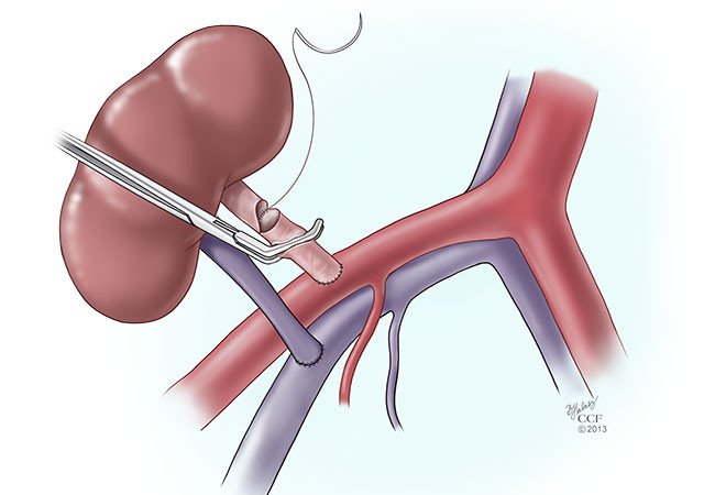 Kidney transplantation procedure