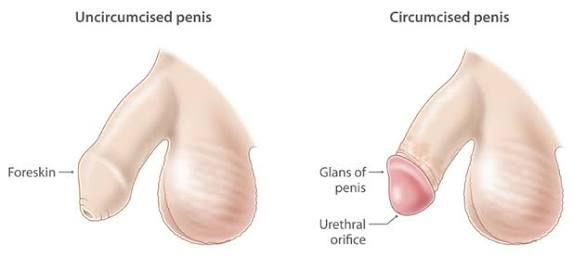 Male circumcision