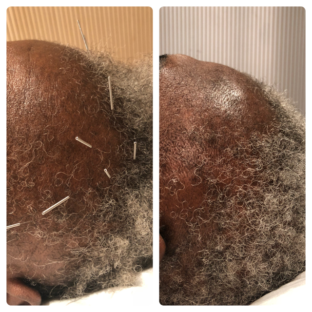 Hair Loss (Alopecia) Treatment