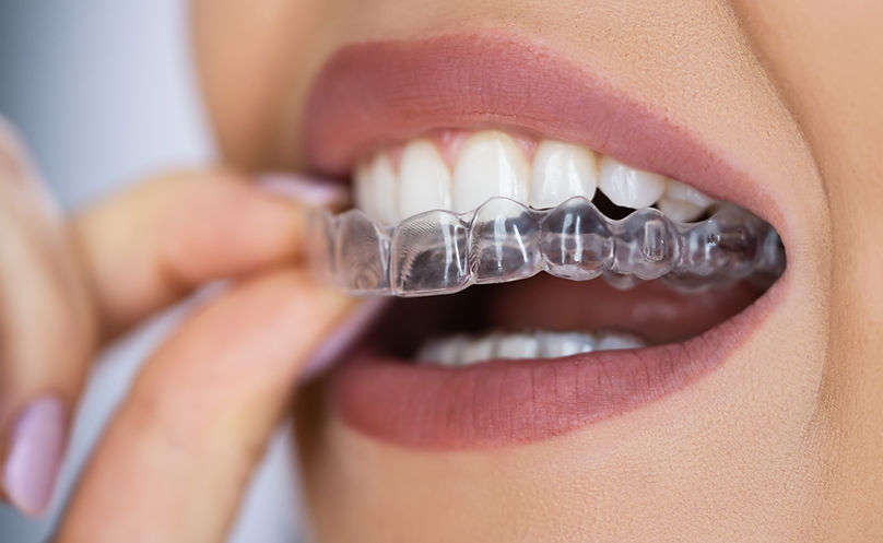 Aligners stock 3.jpg
